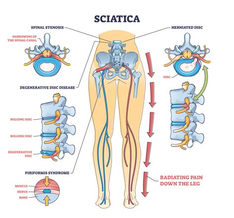 grafico che illustra il percorso diagnostico per il mal di schiena e la sciatica