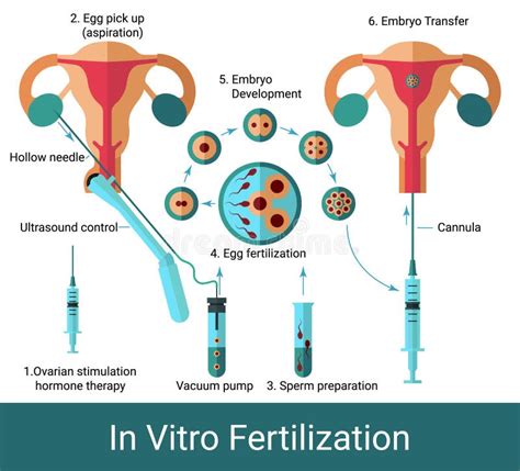 Schema di fecondazione in vitro