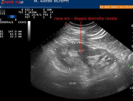 ecografia doppler renale fetale con evidenza di vascolarizzazione