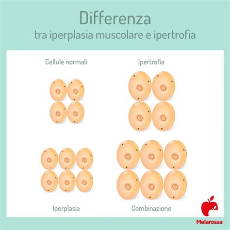 confronto ecografico tra ipertrofia di Bertin e neuroblastoma fetale