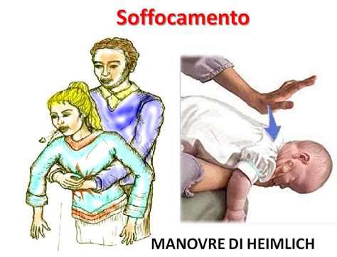 Segni di soffocamento nel bambino