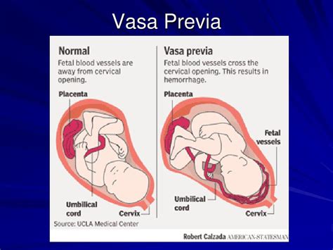 schema diagnostico della placenta previa e vasa previa