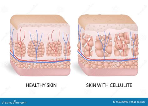 Schema anatomico della cellulite