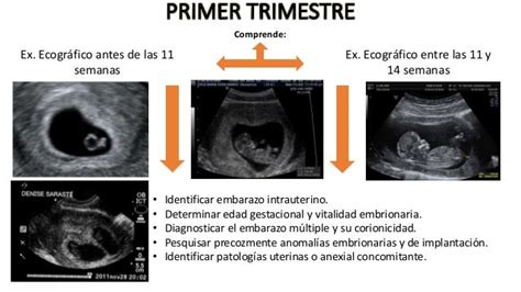 Ecografia 1° trimestre feto