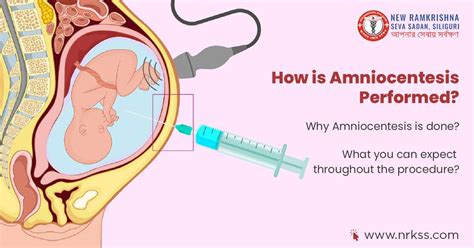 Amniocentesis procedure step-by-step diagram