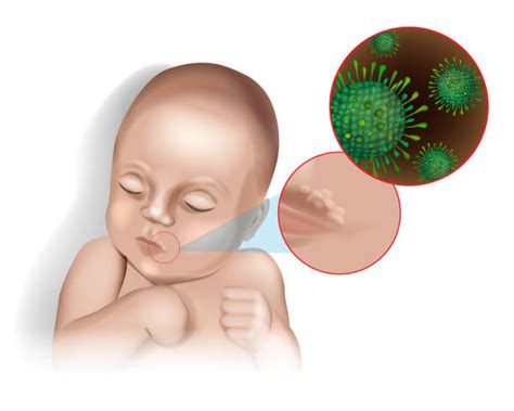 illustrazione di stomatite nel bambino