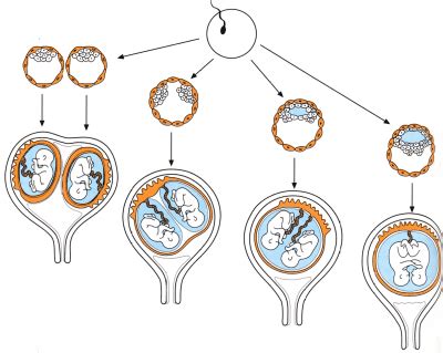 Immagine ecografica di gemelli monocoriali biamniotici con placenta condivisa