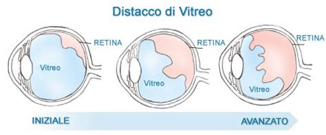 illustrazione grafica del distacco del corpo vitreo dalla superficie retinica