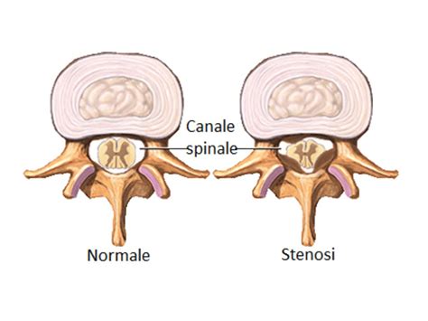 illustrazione di una colonna vertebrale con evidenziata la stenosi spinale