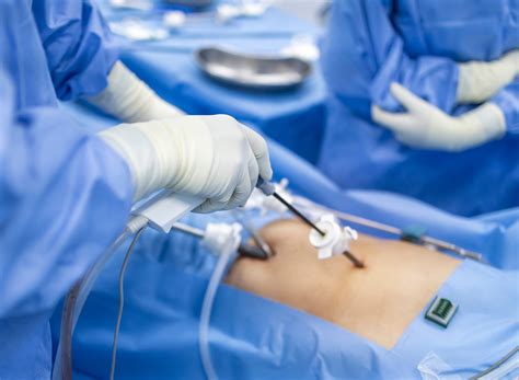 Illustrazione di chirurgia ginecologica mini-invasiva