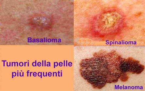 Illustrazione di vari tipi di tumori che producono hCG, come il coriocarcinoma e la mola idatiforme