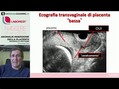 rappresentazione ecografica di una placenta in fase di sviluppo precoce