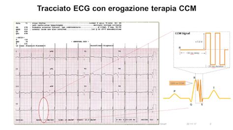 Esempio di artefatti sul tracciato ECG dovuti a tremore muscolare