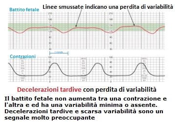 Schema che illustra i diversi tipi di decelerazioni fetali (precoci, variabili, tardive)