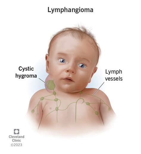 Infografica riassuntiva su cause, diagnosi e trattamento del linfangioma cistico