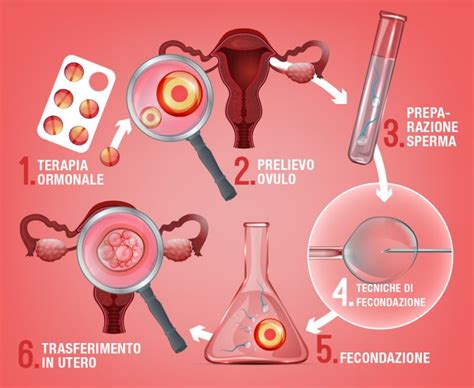 Schema delle tecniche di procreazione medicalmente assistita