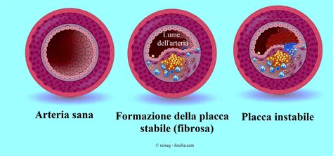 infografica che illustra il flusso sanguigno in un'arteria sana rispetto a una arteria con placca aterosclerotica