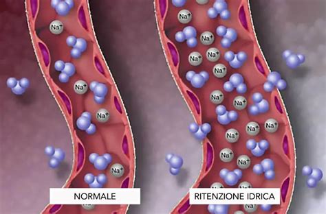 Diagramma che mostra la ritenzione idrica nel cristallino e il suo effetto sulla messa a fuoco