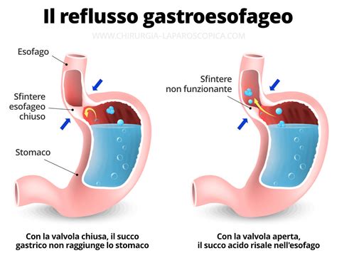 Illustrazione schematica dell'esofago e dello stomaco con frecce che indicano il reflusso di acido gastrico