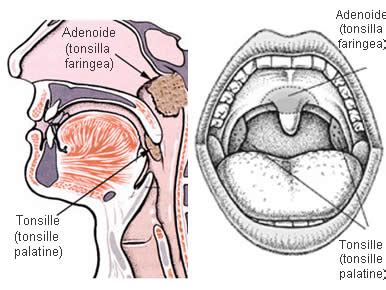 diagramma che mostra l'ostruzione delle vie aeree causata da tonsille e adenoidi ingrossate