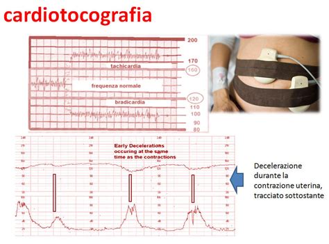 Diagramma di una cardiotocografia fetale con spiegazione delle onde