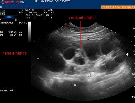 Ecografia fetale che mostra un rene multicistico