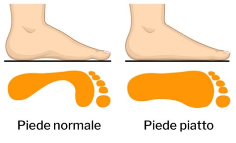 Diagramma del piede piatto flessibile e rigido