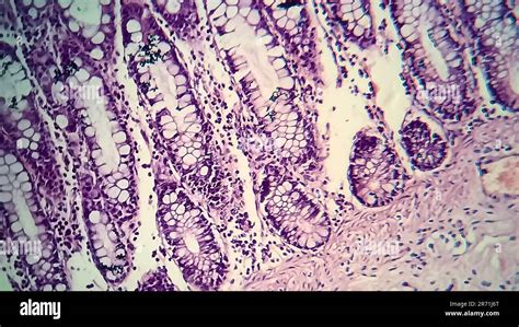Microscopio che evidenzia l'infiammazione intestinale