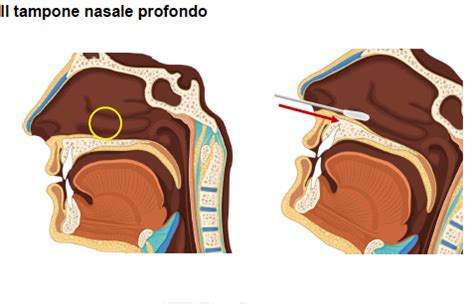 Tecniche di prelievo del tampone nasofaringeo e aspirato nasale