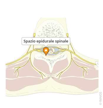Illustrazione anatomica dello spazio epidurale e dell'inserimento del catetere