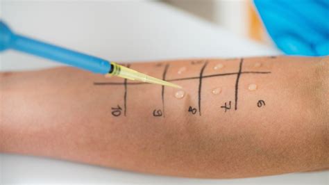 schema del prick test effettuato su un braccio di un bambino