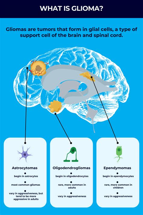 Illustrazione del glioma delle vie ottiche
