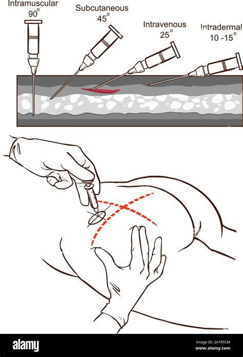 Illustrazione anatomica che mostra la corretta sede di iniezione intramuscolare nel braccio di un bambino