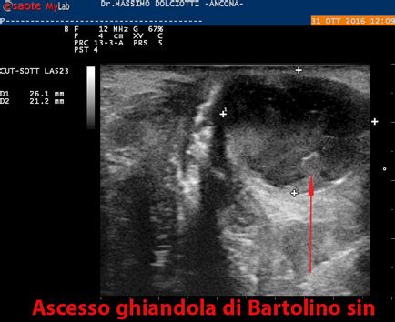 Ghiandole di Bartolino