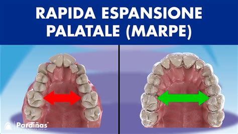 infografica che mostra lo sviluppo corretto del palato rispetto a una malocclusione
