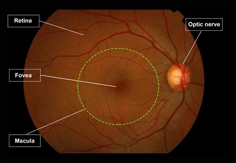 diagramma esplicativo della macula retinica e del rischio genetico