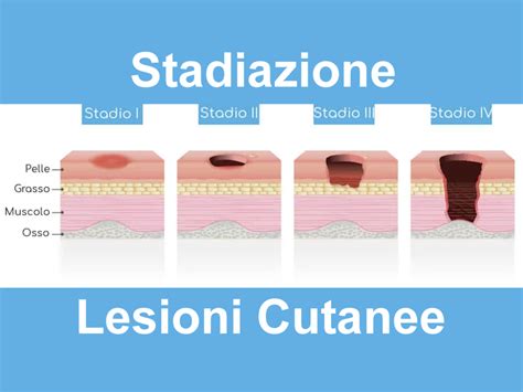 Illustrazione delle diverse localizzazioni e profondità delle lesioni di ACC