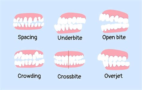 Infographic showing different types of malocclusions (open bite, crossbite, deep bite).