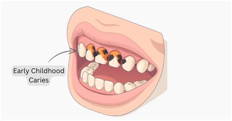 Image showing examples of early childhood caries and dental erosion.