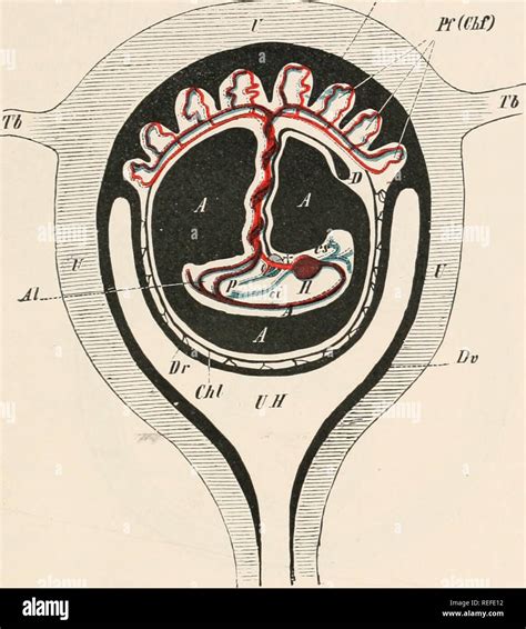 rappresentazione schematica dell'utero in caso di aborto interno