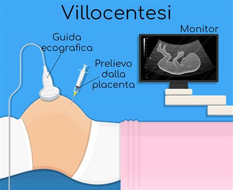 illustrazione di un medico che esegue una villocentesi sotto guida ecografica