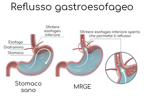 Reflusso gastroesofageo nel neonato