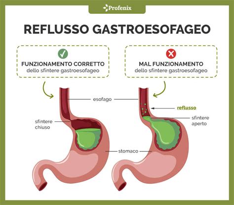 Scintigrafia reflusso gastroesofageo procedura