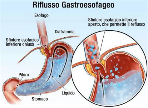 diagramma esplicativo del reflusso gastroesofageo nel lattante