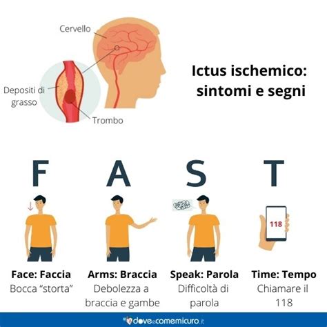 Infografica BE FAST per il riconoscimento dell'ictus