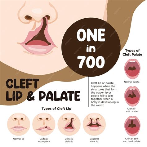 illustration of cleft lip and palate
