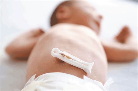 pinza ombelicale sterile su un neonato