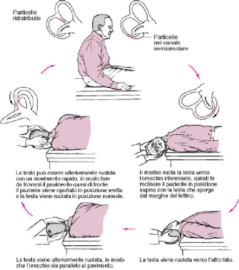 Schema illustrativo della manovra di versione cefalica esterna