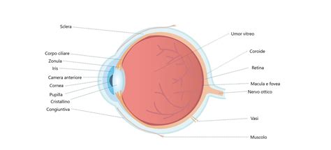 Illustrazione dell'iride che si stacca dal corpo ciliare (iridodialisi)