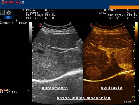 Microbolle di mezzo di contrasto ecografico